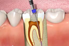 endodonzia