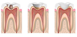 Fillings